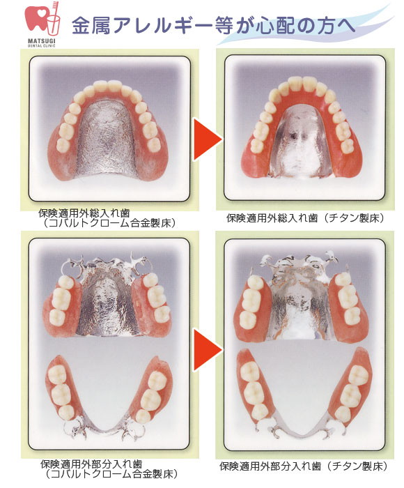 金属アレルギーが心配の方へ