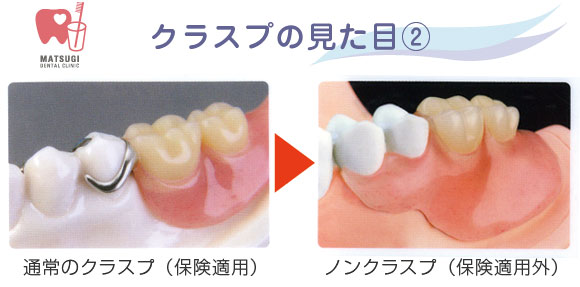 クラスプの見た目2