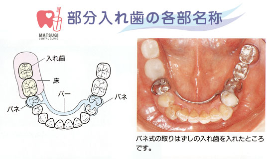 部分入れ歯の各部名称