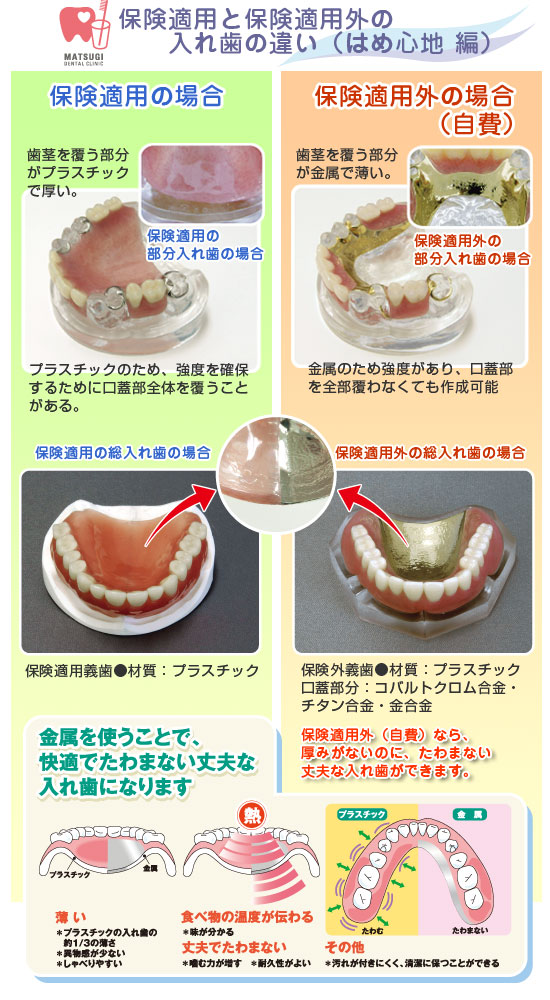 保険適用と保険適用外の入れ歯の違い