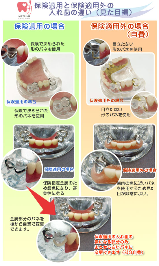 保険適用と保険適用外の入れ歯の違い